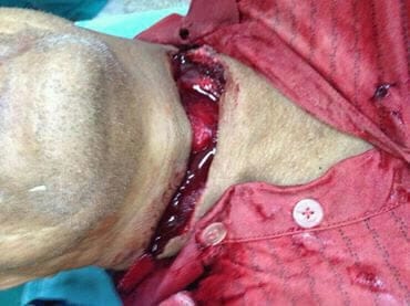 Médico cirurgião faz apelo de rede social contra uso de linha com Cerol