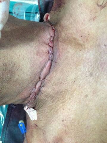 Cerol quase mata motociclista e médico cirurgião faz apelo em rede social