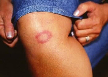 Acre registra mais de 100 novos pacientes com hanseníase e fica em 8º no ranking de estados com mais casos da doença