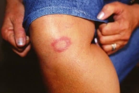 Acre registra mais de 100 novos pacientes com hanseníase e fica em 8º no ranking de estados com mais casos da doença