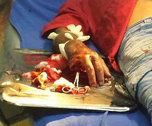 Adolescente decepa dedos de cunhado com terçado