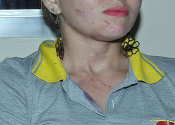 Após agressão, cobradora ficou com hematomas no rosto