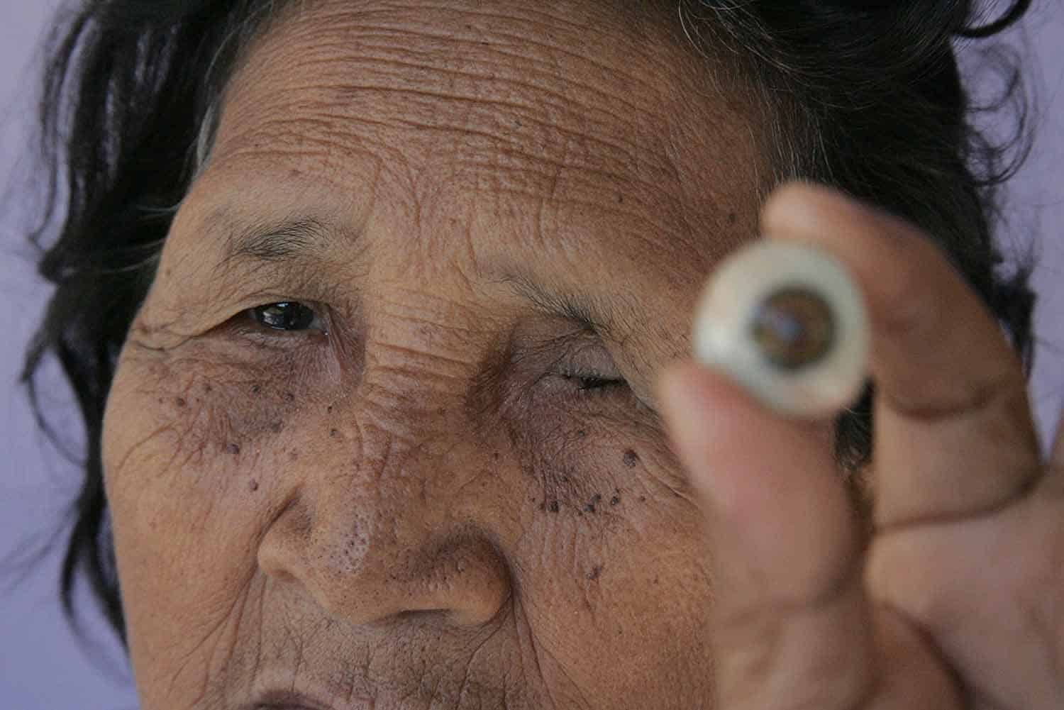  A prótese rígida incomoda dona Ignês; ela pede que a justiça seja feita em relação ao seu caso 