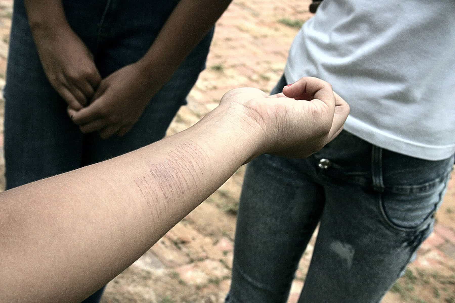 Adolescentes se mutilam em salas de aula e exibem marcas nos pulsos 1 Depressão leva estudantes e praticarem a auto-mutilação. (Foto: Odair Leal/ A GAZETA)