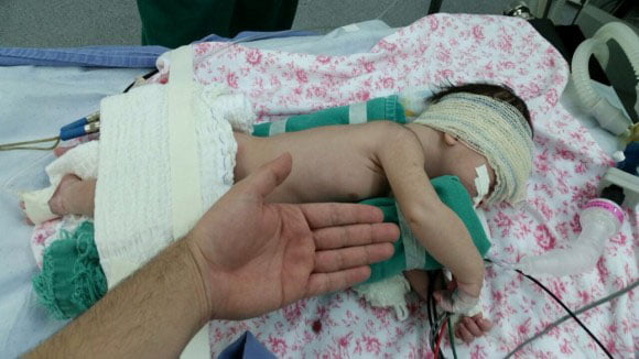 Primeira cirurgia de correção pulmonar em bebê é realizada no Acre 2 O pequeno Rafael aguarda alta hospitalar após cirurgia no pulmão. (Foto: Junior Aguiar Sesacre)