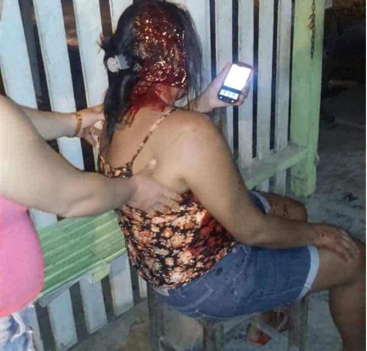 Briga de casal em bar termina com mulher agredida com taco de sinuca 2 Agressão ocorreu em um bar no município de Feijó