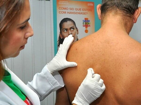Saúde libera recursos para campanha contra hanseníase no Acre e mais 7 estados