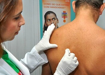 Saúde libera recursos para campanha contra hanseníase no Acre e mais 7 estados