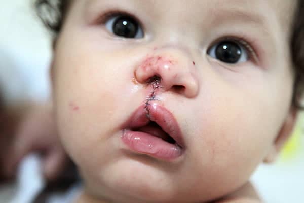 Arthur Teles fez a primeira cirurgia aos seis meses e terá que fazer mais três para corrigir o problema . (foto: ANGELA PERES /  SECOM)