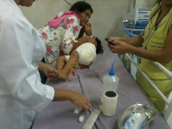 Criança que teve 30% do corpo queimado está com pneumonia, diz mãe