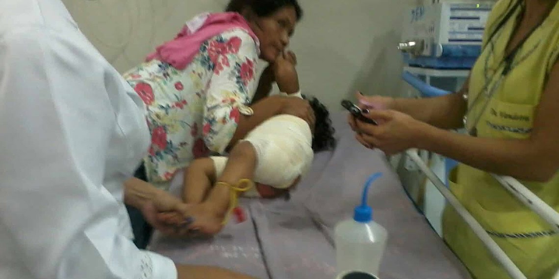 Criança que teve 30% do corpo queimado está com pneumonia, diz mãe